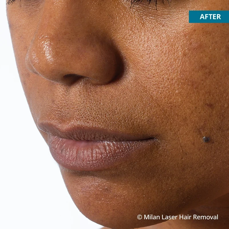 Face Before & After Photos of Laser Hair Removal | Milan Laser in Akron, OH