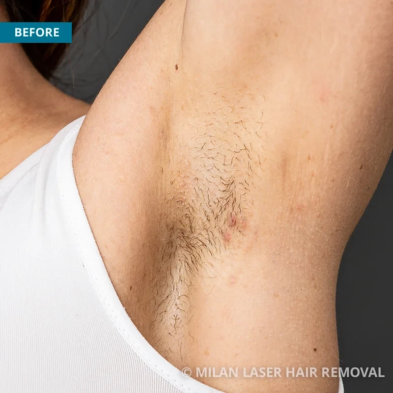 Underarm Before & After Photos of Laser Hair Removal | Milan Laser in  Akron, OH